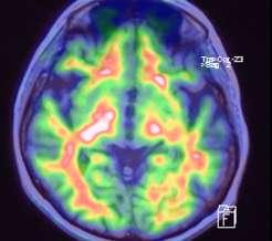 specificita amyloidového PET Amyloid PET PET/MRI (negativní) Palmquist