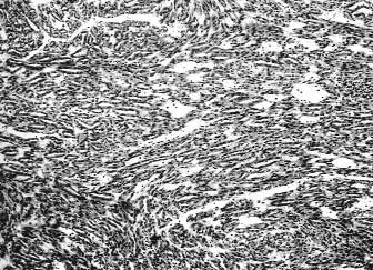 Papilární renální karcinom (papillary renal cell carcinoma), chromofobní renální karcinom (chromophobe renal cell carcinoma), karcinom ze sběrných kanálků (carcinoma of the collecting ducts of