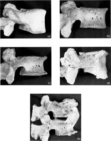 osteofyty > 3mm přemostění Stloukal,