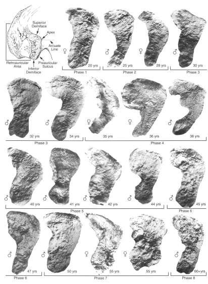 FACIES AURICULARIS morfoskopické znaky příčné zvlnění - postupná ztráta jemná zrnitost reliéfu - ztráta hladkost povrchu resorpce okraje mikroporozita tvorba výrůstků Fáze 1 (20-24 let) Fáze 2 (25-29