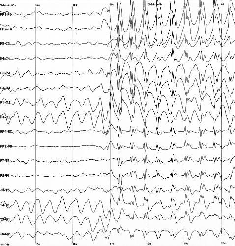 Epilepsie EEG známky