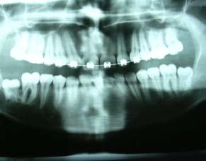 těchto recipientních prostor přeneseny zárodky zubů 48 a 38. U obou zubů byla odstraněna většina perikoronárního vaku a ve stabilní poloze byly překryty mukoperiostem se suturou.