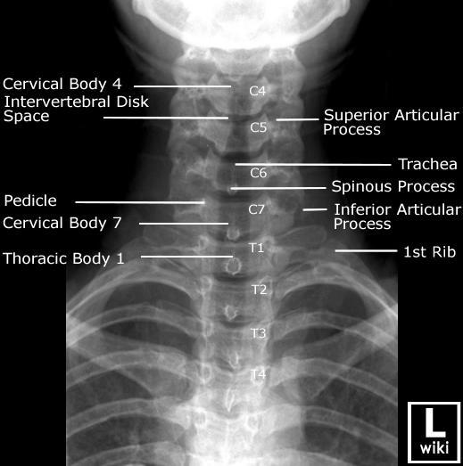 com/vertebral-column-2 Obrázek 51 Snímek krční páteře v