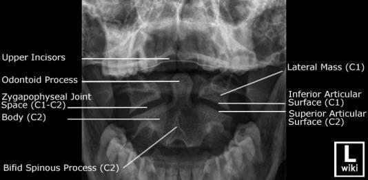 com/vertebral-column-2 Obrázek 56 Snímek krční páteře v