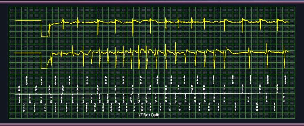 Kedy je ICD terapia nepotrebná Non-sustained VT