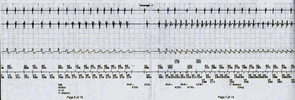 Príčiny neadekvátnej ICD terapie AVNRT... ako ju nepoznáme Intermittentný undersenzing A.