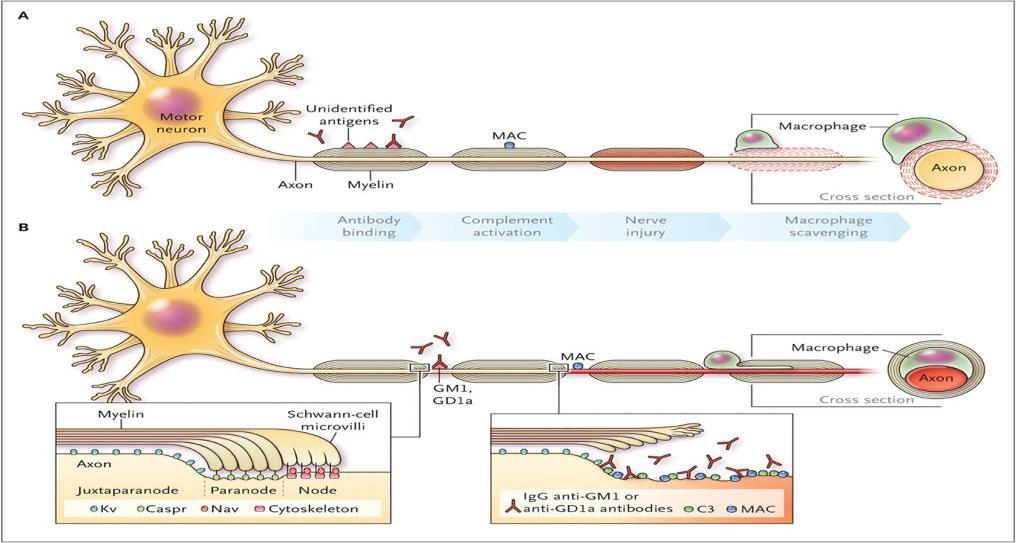 patogeneze a patofyziologie patologická imunitní reakce vůči perifernímu nervu AIDP demyelinizace na podkladě antigangliosidových protilátek a