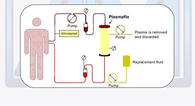 plazmaferéza eliminace patologických součástí plazmy (autoprotilátky, imunokomplexy) membránová