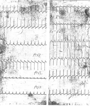 Léčba: pouze základní onemocnění. - syndrom nemocného sinu (sick sinus syndrome) porucha sinoatriálního uzlu s bradykardií, sinoatriálními zástavami a neadekvátní reakcí na zátěž.