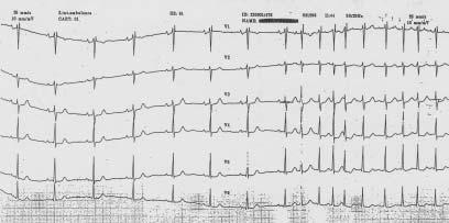 kardioverze elektrická při neúspěchu farmakologické v analgosedaci např. Dormicum (midazolam) výboj defibrilátoru 50-200 Ws za všech kautel defibrilace.