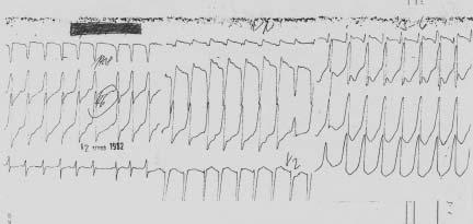Léčba: antiarytmika - mesocain, propafenon, mexiletin, ajmalin, procainamid, někdy i betablokátory, vysazení digitalis, doplnění iontů (K,Ca,Mg), u závažných typů s již proběhlou maligní arytmií