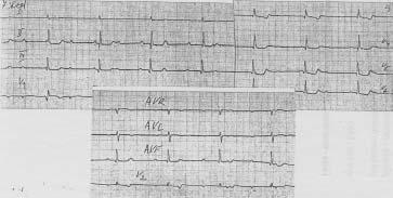 stupeň - kompletní a-v blokáda, síně pracují s frekvencí 70/min, komory cca 30-40/min Léčba: při IM dolní stěny častěji I.