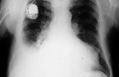 Obr. č. 29 RTG hrudníku nemocného s implantovaným kardiostimulátorem, s dilatací srdečního stínu, plicní hyperémií a pravostranným fluidothoraxem.