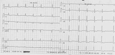 2.5.2 Chronické formy ICHS 2.5.2.1 Stabilní angina pectoris Definice: tlaková, pálivá, řezava bolest na hrudníku provokovaná v průběhu času stále stejnými a stejně silnými podněty (námaha, studený protivítr, příjem potravy apod.