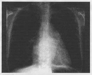 Zúžení mitrálního ústí znamená větší zátěž levé síně, která hypertrofue až dilatuje, tím se přetížení přenáší zpětně do plicního řečiště tendence k hemoptýzám a plicnímu edému.