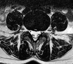 anulus fibrosus koncentrické, transvezální