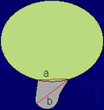 Spine 2001;26(5):E93 E113 Bulging disk vyklenutí disku v rozsahu