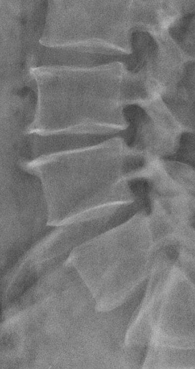 vyjadřující přítomnost osteofytů spondylosis