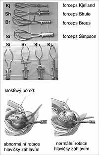 Příloha 2 Klešťový porod ZDROJ: PORODNÍCI.