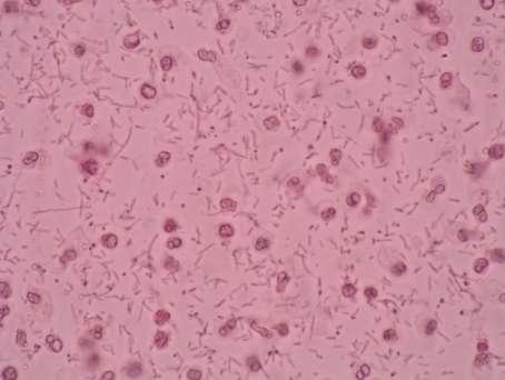 Obrázek 14: Fuchs-Rosenthalova komůrka bakteriální meningitida (neutrofilní granulocyty a bakterie) (200x).