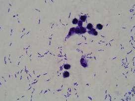 granulocyty a bakterie), b) bakteriální meningitida (neutrofilní granulocyty a velké mononukleáry) (1000x).