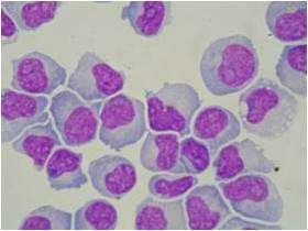 a) b) Obrázek 19: Cytologický preparát a) i b) Akutní lymfoblastická leukémie - lymfoblasty (1000x). (Autor fotografie: Ilona Fátorová) 2.
