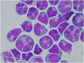 Podle buněčných elementů lze patologickou oligocytózu rozdělit na oligocytózu lymfocytární, monocytární, případně lymfo-monocytární, granulocytární a tumorózní. (Dufek, 2002) 2.3.2.1.