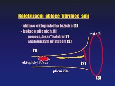 v nich často mezery (gapy). Takto nedostatečně poškozená, a tedy vodivá tkáň, dovoluje recidivy FS [10].