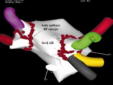 V místě s nejčasnějším záznamem potenciálu PŽ (označeno šipkou) je aplikována RF energie: během ablace pak dochází k oddělení (disociaci) potenciálu PŽ od síňové aktivity (podobně jako např.