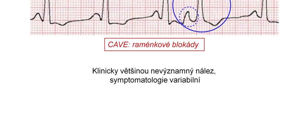 Síňová extrasystola je jednou z nejčastějších abnormalit, kterou na EKG nalézáme. Při jinak pravidelném rytmu najdeme 1 či více komplexů QRS, které jsou v záznamu nepravidelně.