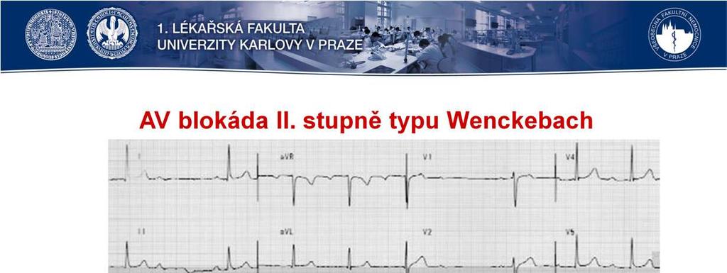 Mobitz Iznamená postupné prodlužování PR intervalu až nakonec dojde knepřevedení vzruchu s výpadkem jednoho QRS. Po tomto výpadku se celý proces opakuje.