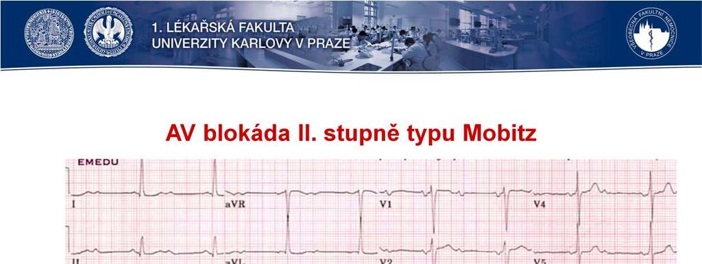 Mobitz IIznamená opakované výpadkyqrs za vlnou Pbez změn v PR intervalu.