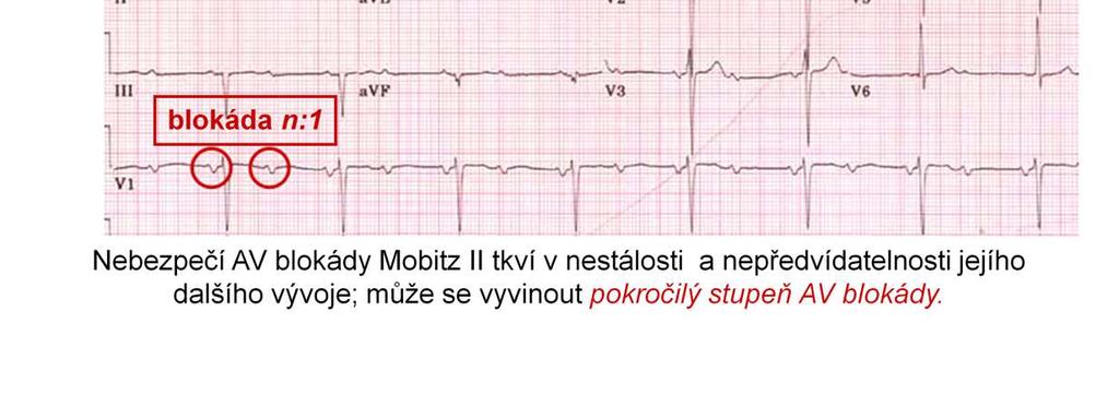 prodlužování dobyp-q. Nebezpečí spočívá vriziku přechodu tohoto bloku vav blok III. stupně.