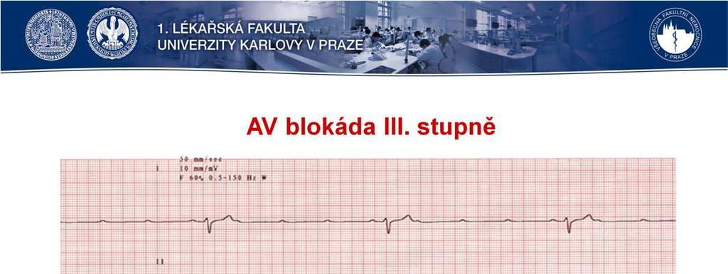 AV blokáda III. stupně znamená naprostou neprůchodnost AV uzlem a tedy oddělení funkce síní a komor. Komory pracují ve svém vlastním rytmu, důsledkem je spíše těžší bradykardie.