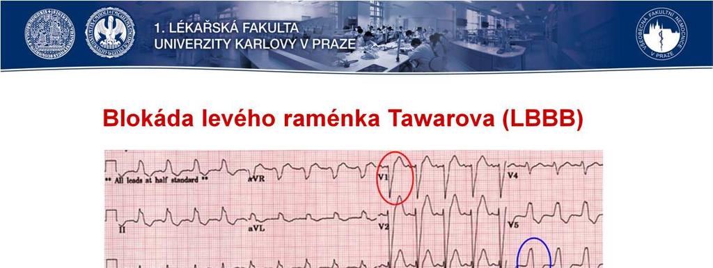 Při blokádě levého Tawarova raménka je změněna aktivace nejen levé komory, ale taktéž mezikomorového septa (to je totiž fyziologicky aktivováno zleva).