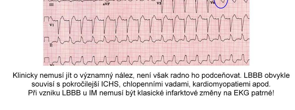 notching), V5, V6 (I, avl) *negativní T s descendentními depresemi ST v týchž svodech *hluboký kmit QS či rs ve V1-V3 sascendentní elevací ST Klinicky nemusí jít o významný nález, není však radno ho