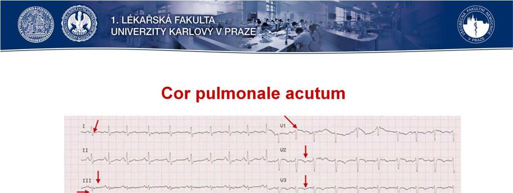 EKG známky akutního cor pulmonale: -S I -Q III s neg. T III -neg. T ve V1-3 (vzácně V4,5 popř.