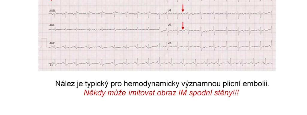 inkompletní BPRT -tachykardie akutní embolie plicnice; většinou jen hemodynamicky významná Pozor: EKG obraz