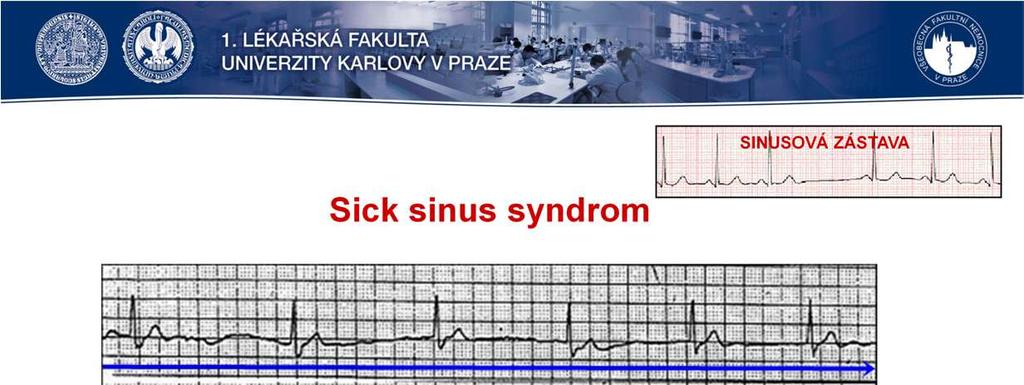 Sick sinus syndrom (SSS) je relativně častým nálezem u starých lidí. Odpovídá poruchám tvorby vzruchu vsa uzlu.