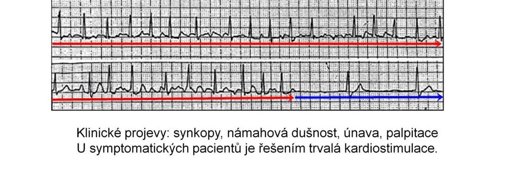 Při SSS můžeme najít sinusovou bradykardii, AV blokády, tachyfibrilaci sínínebo jiné poruchy rytmu.