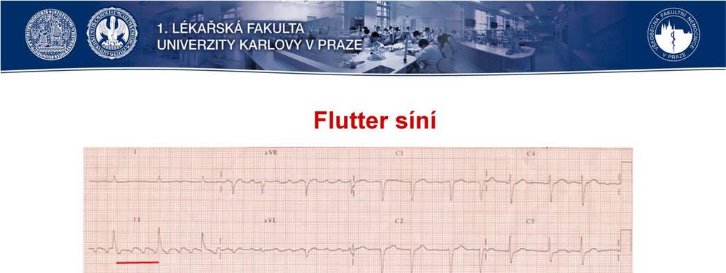 Flutter síní vzniká velmi často při dilataci jedné nebo obou síní. K dilataci LS dochází např.