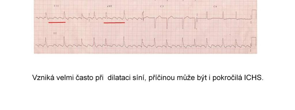 Příčinou flutteru bývá často také pokročilé stadium ischemické srdeční choroby u tohoto