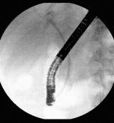 5: kontrolní cholangiogram po úspěšné endoskopické léčbě, s výborným, optimálním efektem nyní je v místě původní těsné biliární stenózy v oblasti společného hepatiku prakticky normální nález. Obr. 10.