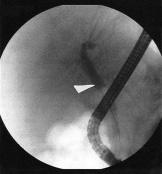 na BK po LCE, podobně jako u jiných autorů [2,19,20], poměrně nízký. V naší práci byla provedena pouze diagnostická ERCP u 16,3 % pacientů (15 z celkového počtu 92 pacientů).