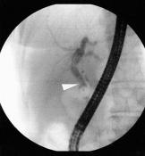 souboru pacientů byly komplikace terapeutické ERCP přítomny v 3,90 %. Reziduální CDL byla nejčastějším nálezem v našem souboru u 64, 13 % pacientů (59 pacientů z 92).