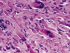 Show fluid in the 1st MTP joint (arrow) and erosion of the medial aspect of the head of the 1st metatarsal bone (arrow),