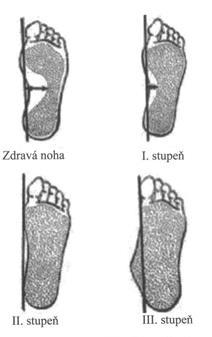 1 TEORETICKÁ VÝCHODISKA DANÉ PROBLEMATIKY Obr. 10 Rozložení ploché nohy Adamec, 2005 (in Reismüller, Levitová 2015, str.