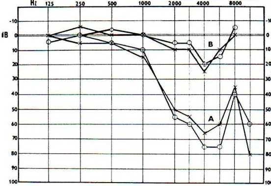 frekvencích s maximem c 5, tj. 4000 Hz. V této oblasti bývá tinnitus. (Hybášek, 1999, s. 160). Takovéto akustické trauma může být způsobeno např.