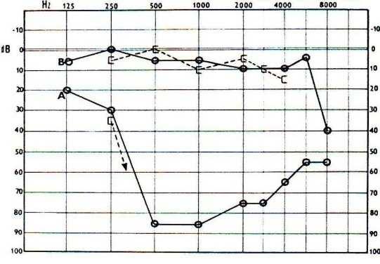 Obr. 12. Audiogram 6letého chlapce po zakřičení do ucha. A-před terapií, B-po terapii. Převzato: Hybášek, 1999, s. 161 Obr. 13. Audiogram 50letého muže po výbuchu pneumatiky v garáži.