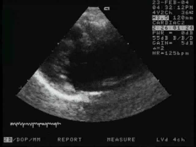 Echocardiography in arrhythmia TTE as first choice: LV size, contractility? LVEDP, preload catecholamines? Valves: MS, MR, AS sig.? Dilated LA? Spont.